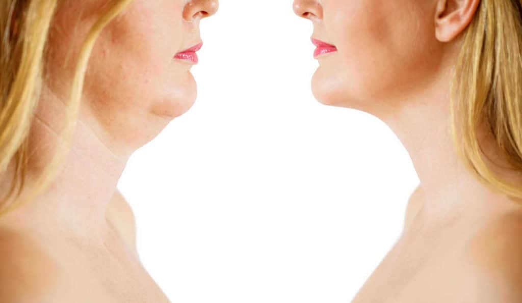 Double Chin treatment Lutterworth before and after results