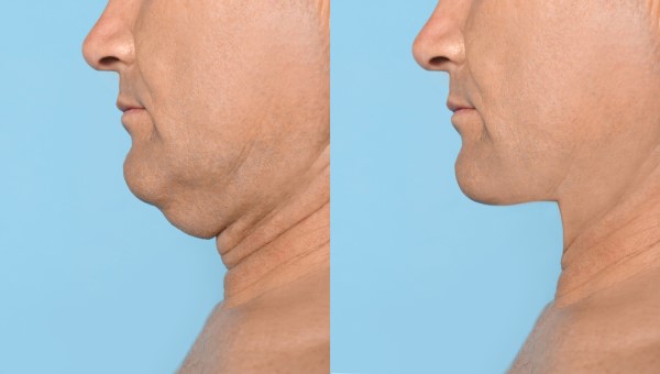 Which Non-Surgical Treatments Work Best for Jowls and Loose Skin Lutterworth?