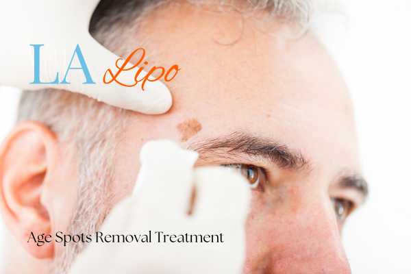 What Are the Most Effective Treatments for Age Spots Lutterworth?