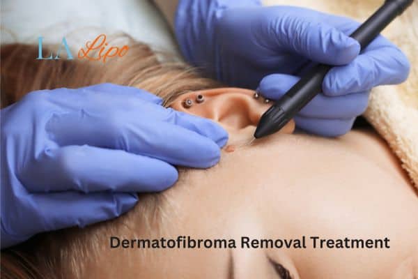 Dermatofibroma Removal Treatment Lutterworth