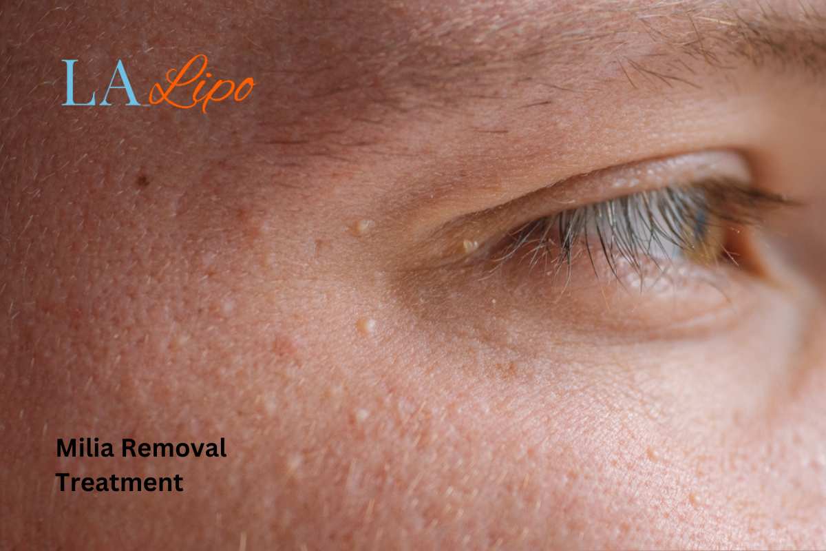 Cryopen Milia Removal: Is It the Easiest and Safest Option Lutterworth?