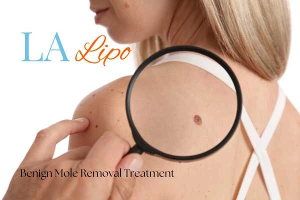 Why getting moles removed Lutterworth can boost your confidence!