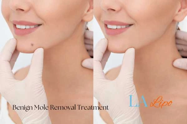 woman's before and after mole removal Lutterworth results