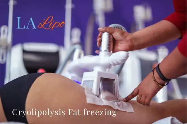 women getting fat freezing Lutterworth