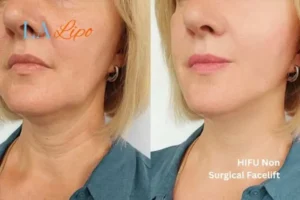 hi-fu for wrinkles Lutterworth before and after results