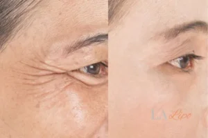 Before and after results of woman - HI-fu wrinkles reduction treatment Lutterworth