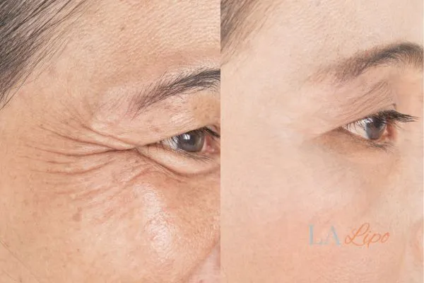 Before and after results of woman - HI-fu wrinkles reduction treatment Lutterworth