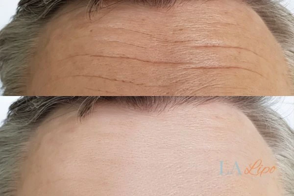 results of HIFU Lutterworth on mans forehead to help reduce lines and wrinkles