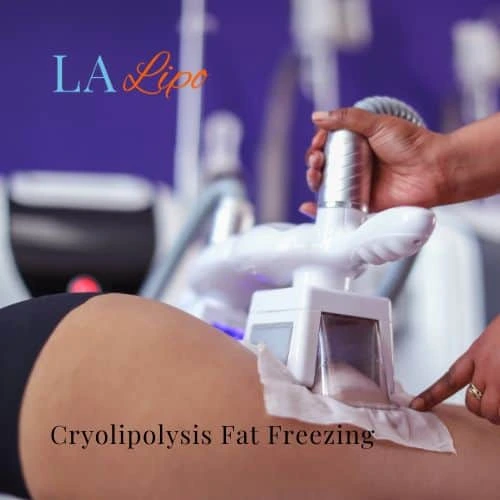 fat freezing - Cryolipolysis Lutterworth