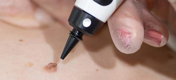 skin tag removal using cryopen Lutterworth