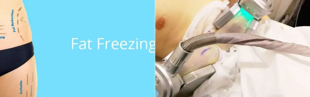 multi areas of a persons body having coolsculpting Lutterworth treatment