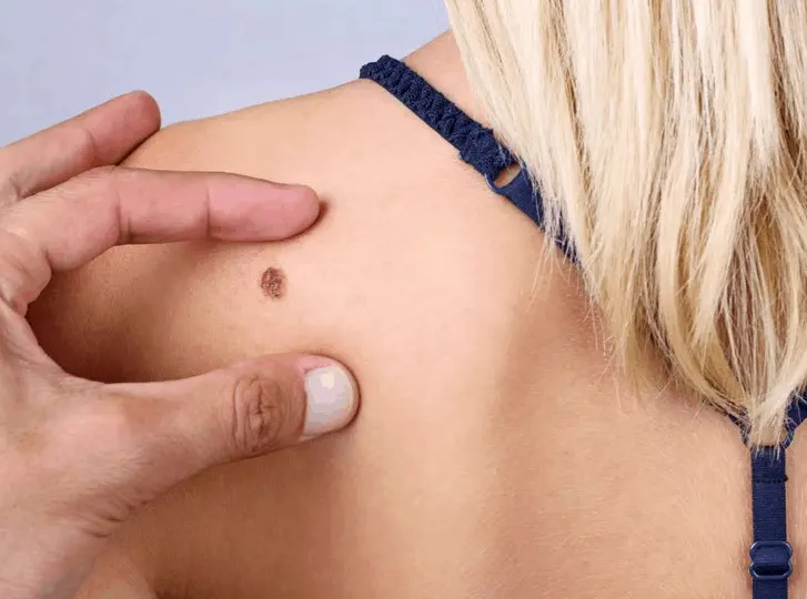 woman having mole removal Lutterworth consultation before treatment.