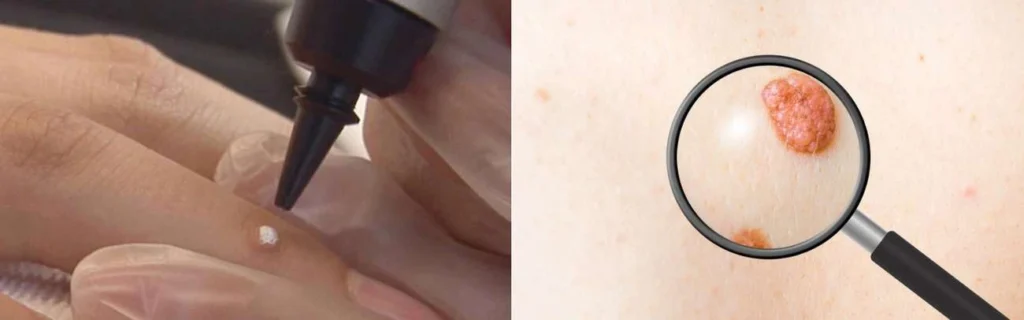 Person getting moles removed with cryopen Lutterworth