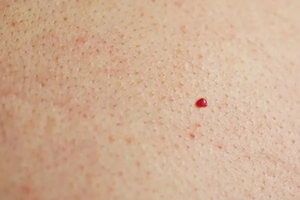 close up of a cherry angioma Lutterworth