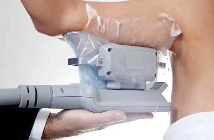Picture of fat freezing Lutterworth on the upper arms.