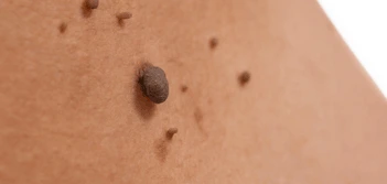 image of a skin tag Lutterworth