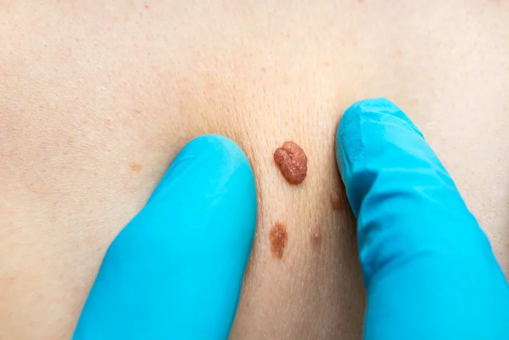 Consultant examining a skin tag Lutterworth