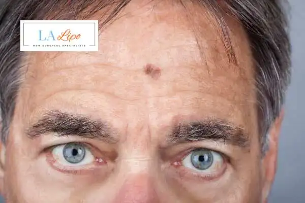 Solar Lentigo Removal Lutterworth image of man with mark on his forehead