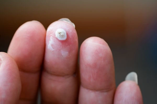 wart on person finger - cryotherapy to treat from LA LIPO Lutterworth