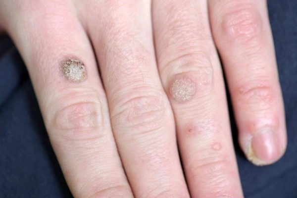 photo of warts on person hand - see wart removal Lutterworth from LA LIPO
