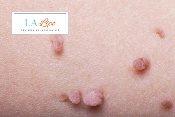 Does cryopen skin tag removal Lutterworth hurt? Find out now call our team today!