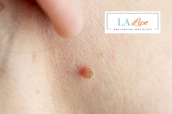 Book skin tag removal Lutterworth today speak to our team now!