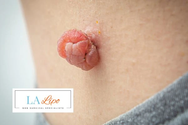 Interested in skin tag removal Lutterworth? Concerned about the pain? Find out more today!