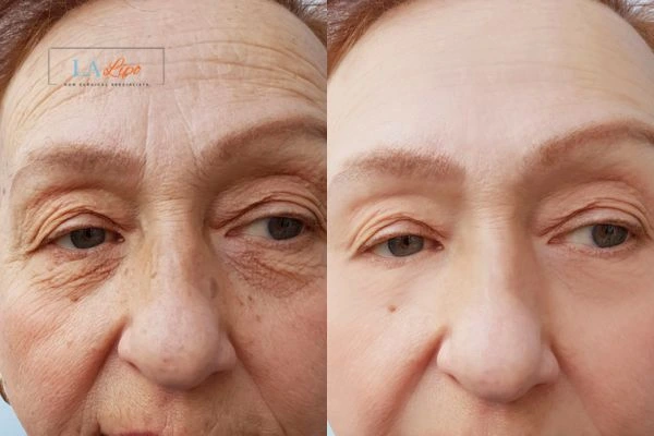 The powerful benefits of Morpheus8 Treatment Lutterworth - Call Our team today!