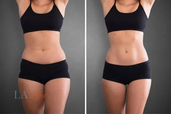 before and after results of non-surgical treatment to help a woman's body image and mental health Lutterworth