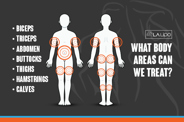 Diagram to show areas you can have LA-EMS Body Sculpting Treatment Lutterworth
