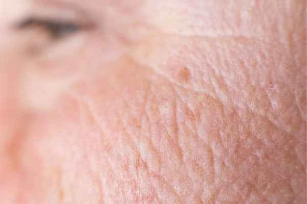 close up picture of a woman's face showing an age spot Lutterworth