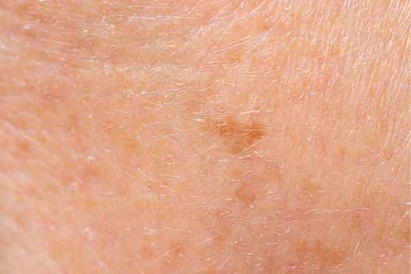close up picture of age spots Lutterworth