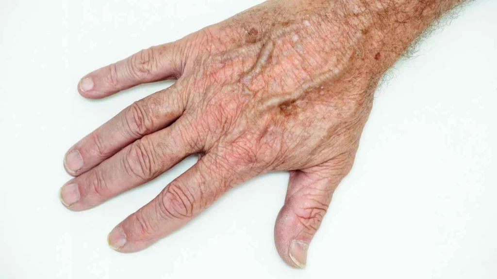 Male hand showing age spot Lutterworth
