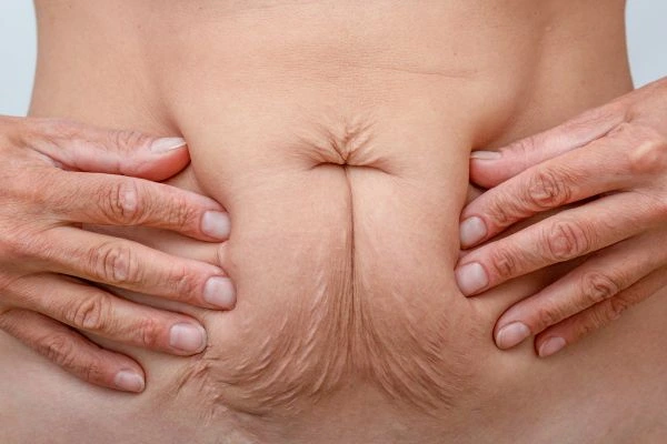 Image of a woman's stomach with loose skin - example of skin tightening Lutterworth options