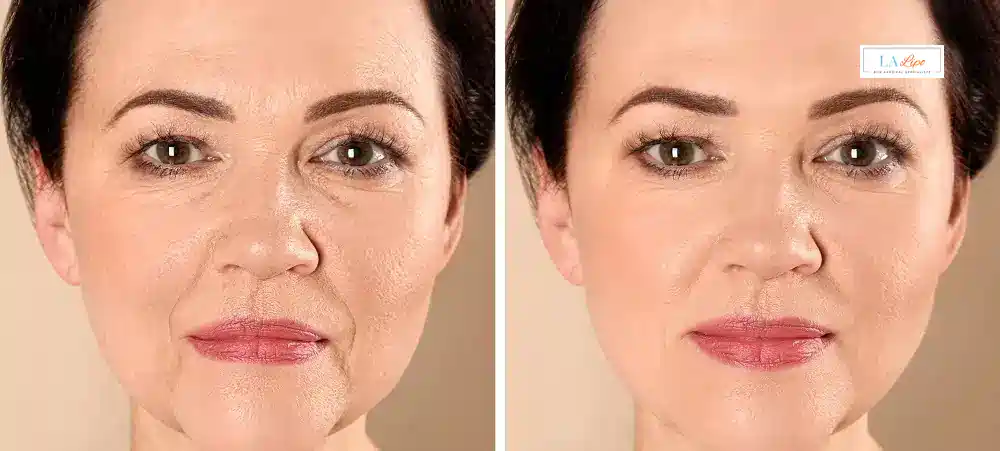 How Long Does It Take to See Results and How Long Do They Last Lutterworth?