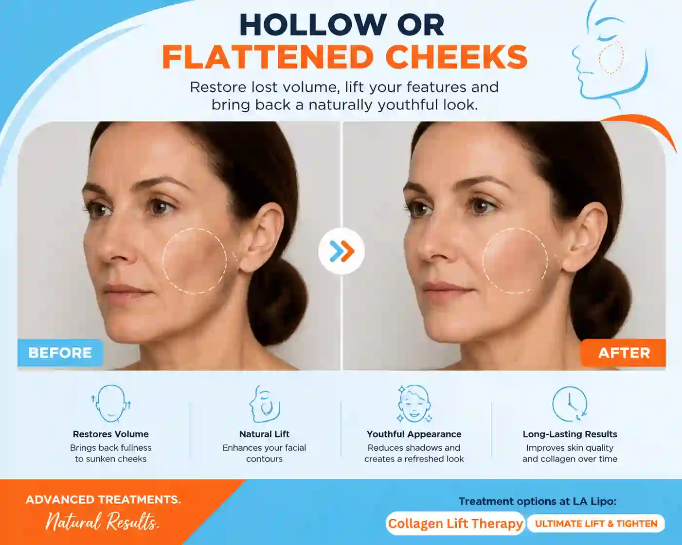 Sign #4: Hollow or Flattened Cheeks Lutterworth